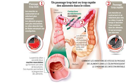 SYNDROME DE L’INTESTIN IRRITABLE (SII) ET NUTRITION