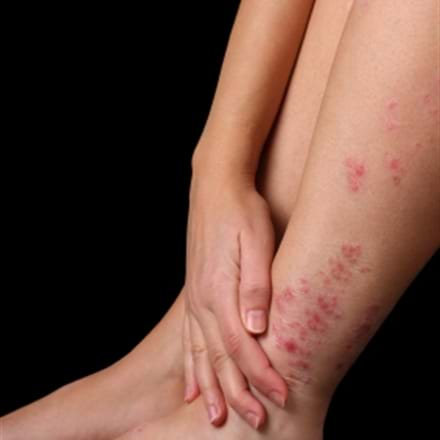 L’ALIMENTATION ET LE PSORIASIS : QUE PEUT-ON FAIRE ?