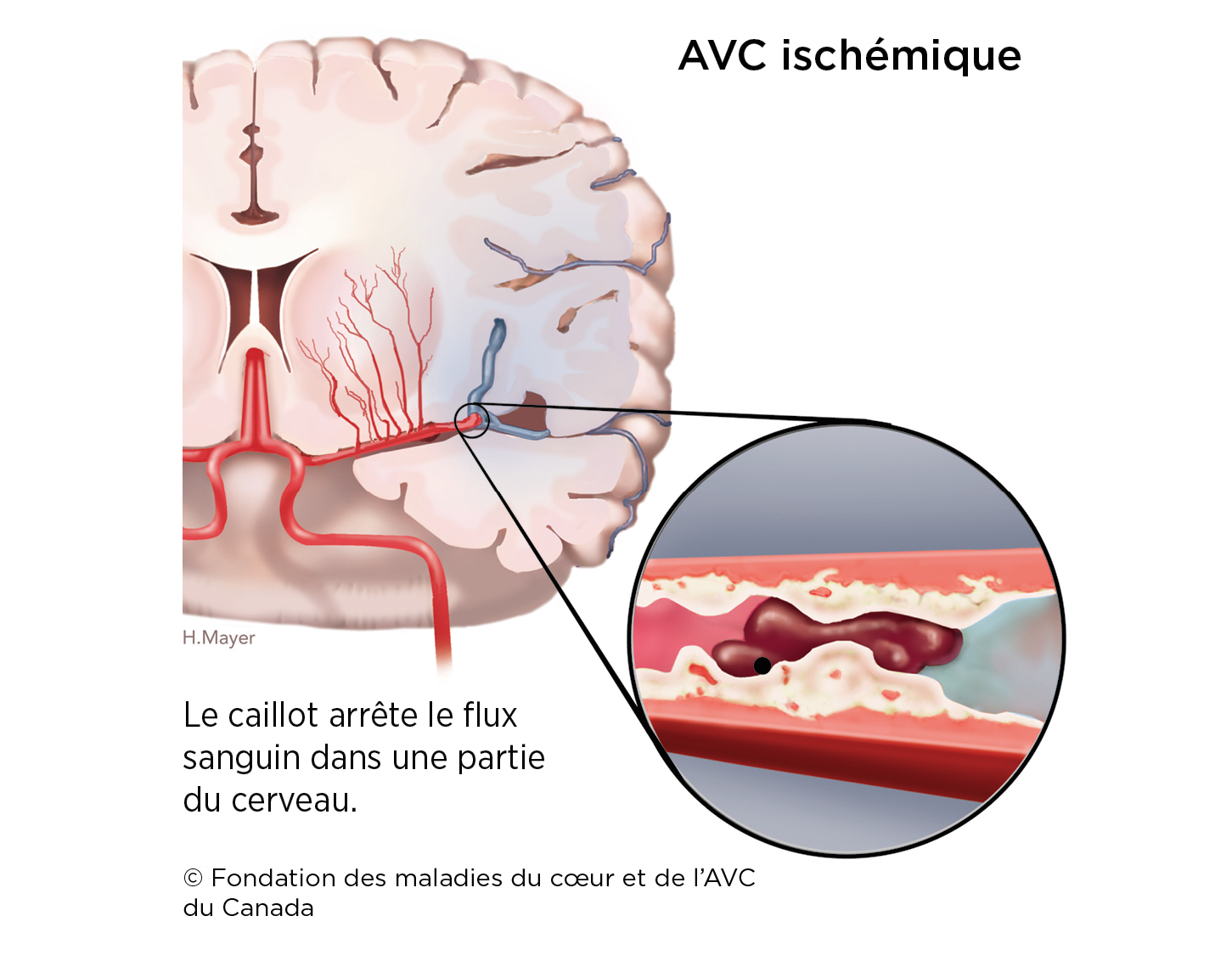 L'AVC expliqué par un médecin