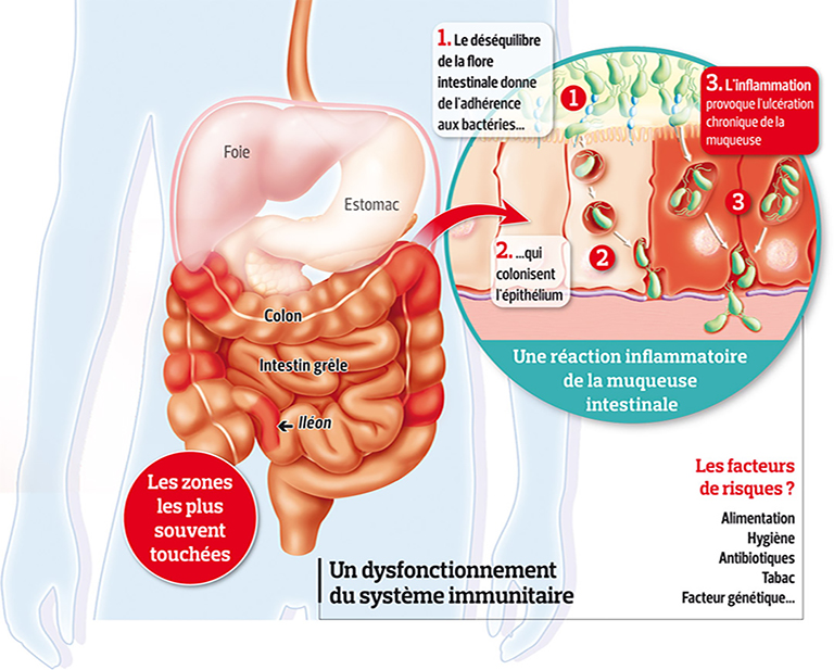 MALADIES INFLAMMATOIRES CHRONIQUES DE L’INTESTIN (MICI) : ACTUALITÉS SCIENTIFIQUES