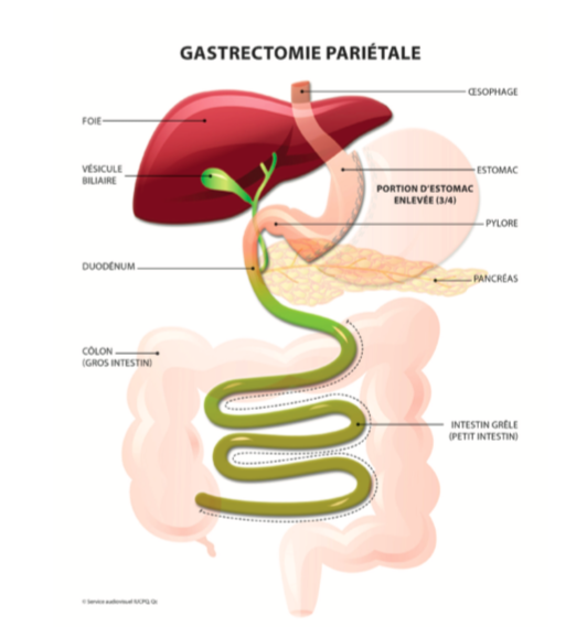 Gastrectomie pariétale (Sleeve)