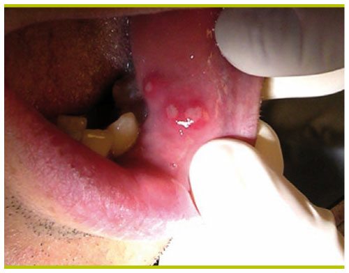 Oral canker sores (ulcers)