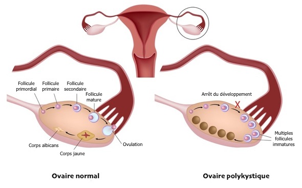 Polycystic Ovary Syndrome (PCOS)