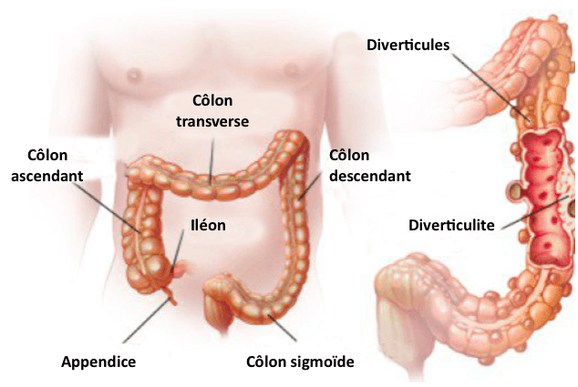 Diverticulosis/Diverticulitis