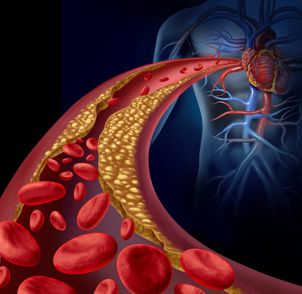 Dyslipidemia