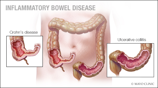 Inflammatory Bowel Diseases