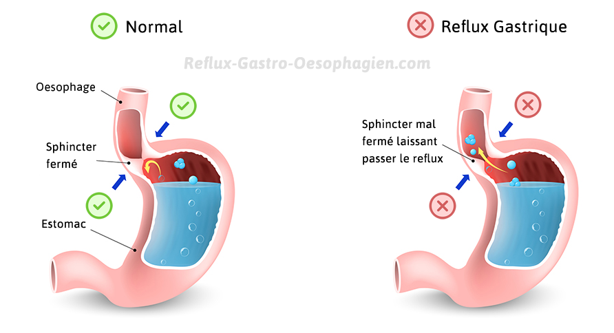 Gastroesophageal Reflux