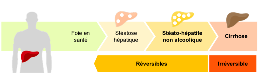Stéatose hépatique non alcoolique ou foie gras (NAFLD)
