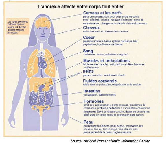 Anorexia Nervosa