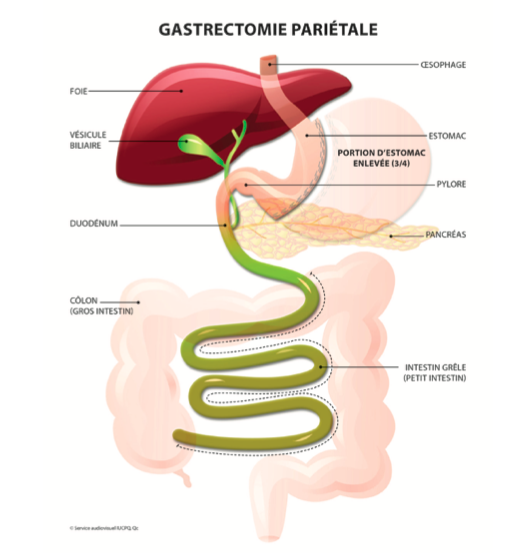 Gastrectomie pariétale (Sleeve) : interventions nutritionnelles et gestion des symptômes