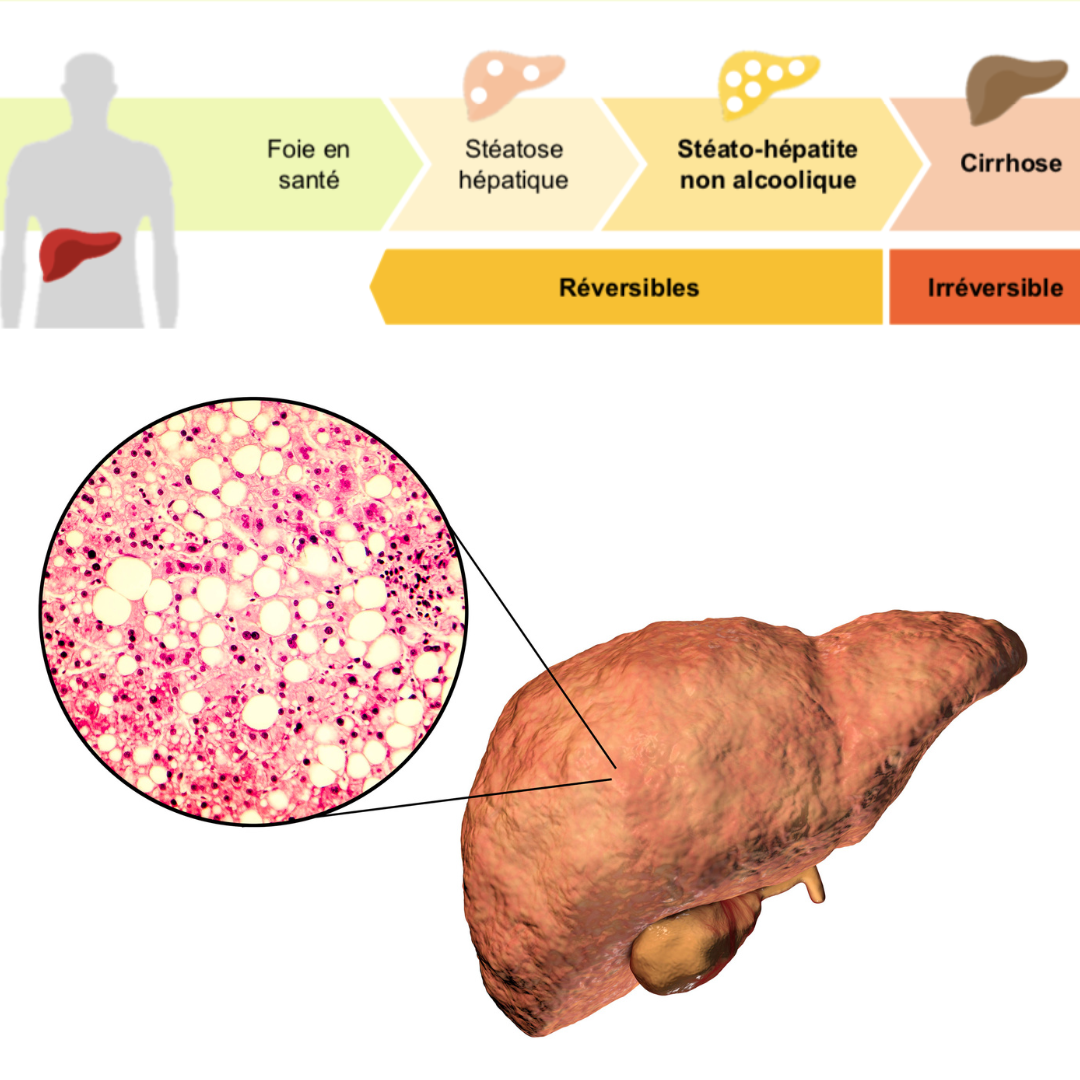 La stéatose hépatique (foie gras), réversible ou non par l'alimentation?